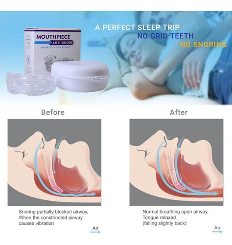 Protector Bucal Antironquidos Para Detener Los Ronquidos Y E