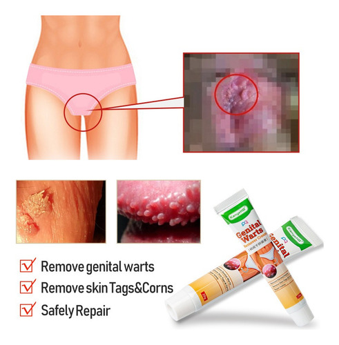 2 Un Ungüento Antiverrugas Para Eliminar Verrugas
