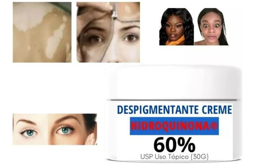 Hidroquinona 60%  30g Melasma,sardas, Manchas, Sol,gravidez