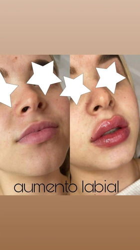 Imagen 3 de 5 de Aumento Y Perfilacion De Labios