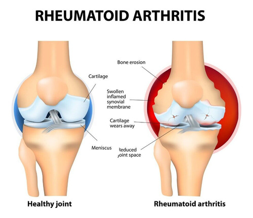 4×crema Para Aliviar El Dolor Muscular La Columna Lumbar