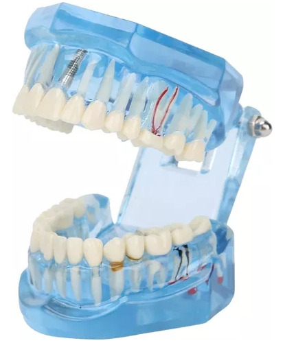 Modelo Dental: Boca Completa - Odontólogo Dental.
