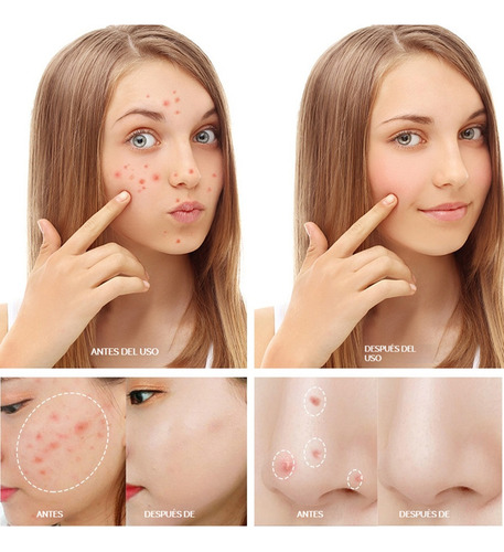 Crema For Eliminar El Acné Centella Asiática Acne Treatment