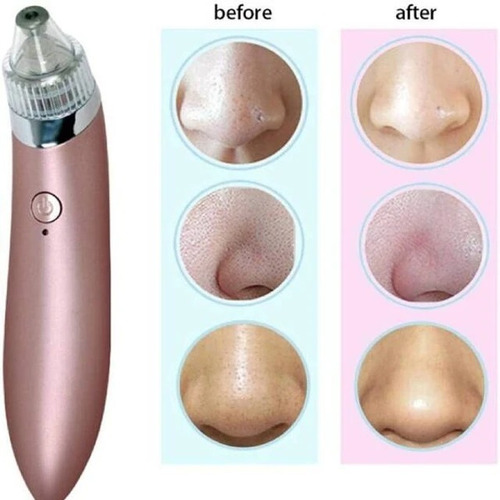 Imagen 4 de 9 de Limpiador Facial Extractor Removedor Saca Puntos Negros
