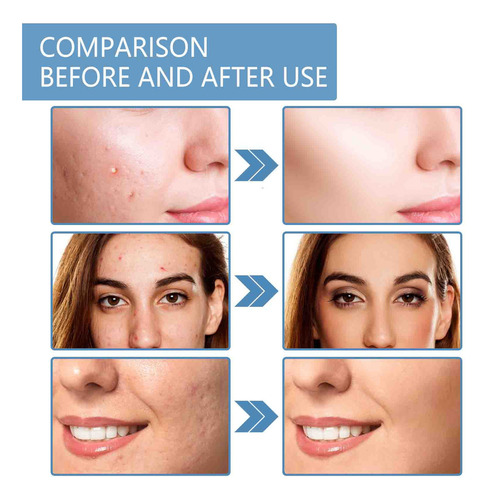Xx Crema Retráctil Crema Salicílica 30 Ml Acid Pore