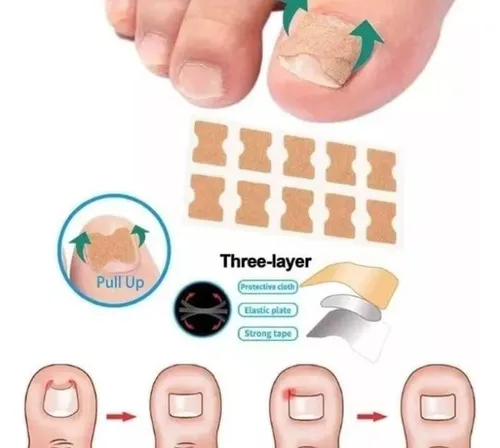 Parche Corrector De Uñas Encarnadas Pack X 10 Unidades