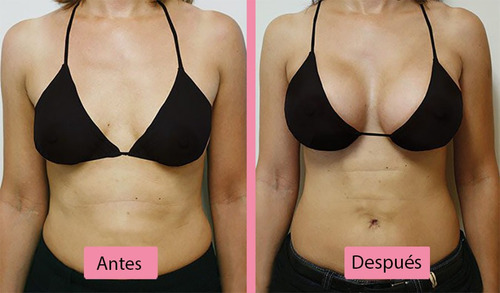 Aumento Crecimiento De Senos Chichis Bubis Tetas Pecho Busto