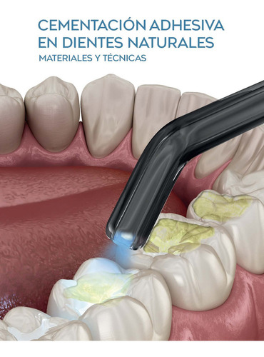 Cementación Adhesiva en Dientes Naturales Materiales y Técnicas de Giacomo Derchi Umberto Campaner Editorial Amolca Tapa Dura