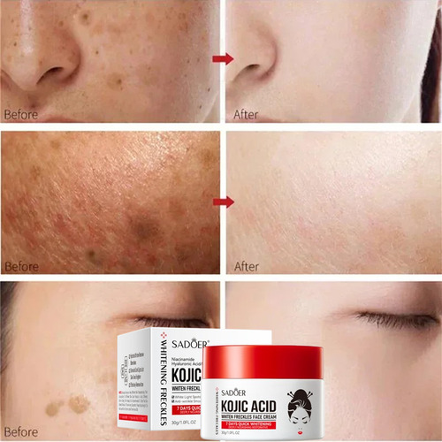 Crema Removedora De Manchas Con Ácido Kójico Para Eliminar E