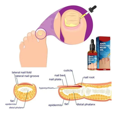 Tratamento Para Reparação De Unhas E Mãos, Gotas