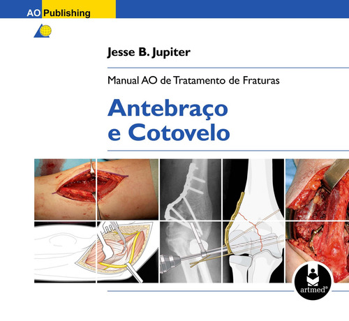 Manual AO de Tratamento de Fraturas: Antebraço e Cotovelo, de Jupiter, Jesse. Artmed Editora Ltda., capa mole em português, 2010