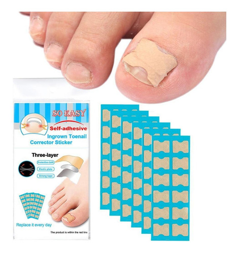 Ss Sroje Tratamiento De Uñas De Los Pies Para Uñas Negras