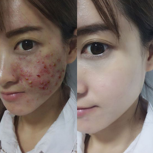 Q 35g Face Removal Cream Pimple Spots Scar Stretch Skin Care