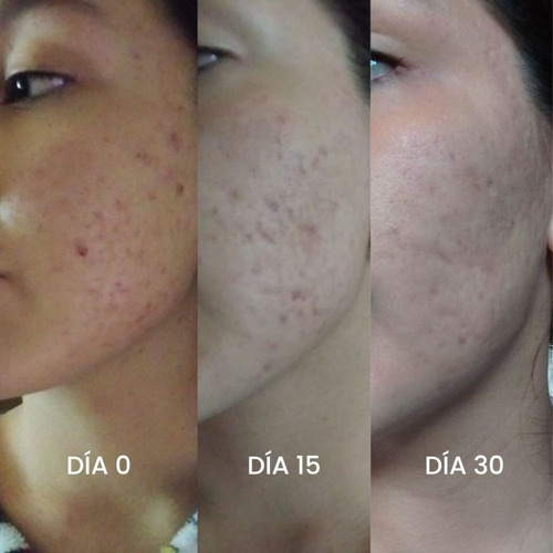 Kit Piel Grasa ( Controla El Acné, Elimina Las Manchas) Momento de aplicación Día/Noche