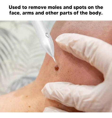 Maquina Profesional Casera Para Remover Vph Condilomas Grano