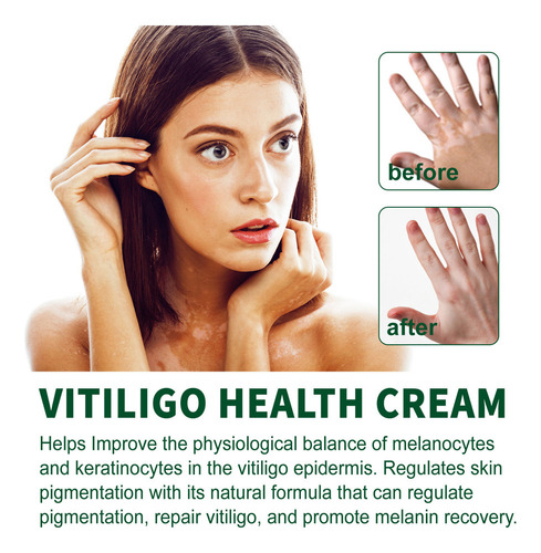 Crema Blanca For El Vitíligo, Pomada For El Vitíligo Local