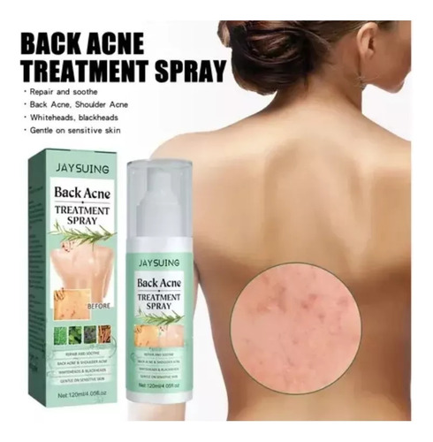 Cure A Acne Nas Costas, Cure A Acne Corporal Com Ácido Salin