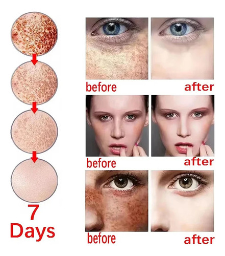 Crema Facial Blanqueadora Para Eliminar Pecas, Melasma Oscur