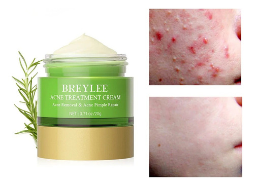  Crema Té Verde Rorec, Anti-acné.Cosmetica Coreana 