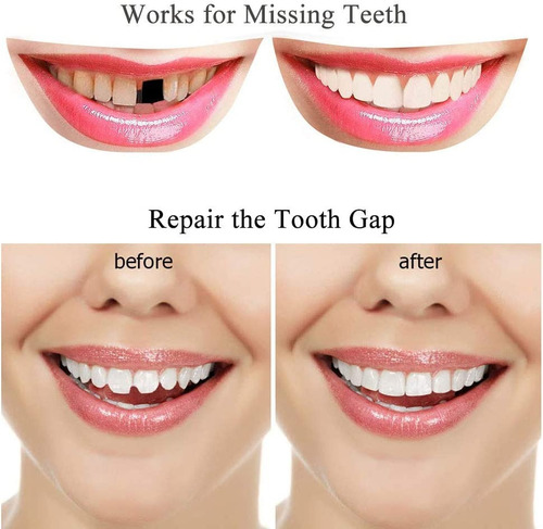 Solucion Temporal De Reemplazo De Dientes Sin Complicaciones