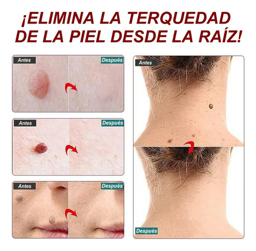 Removedor De Creme Para Remoção De Verrugas E Toupeiras.