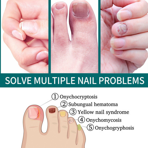 2×reparar Descoloração Das Unhas Onicomicose Suave
