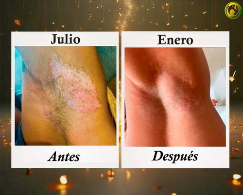 Crema Alba, Para Piel Con Vitíligo