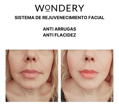 Wondery Levantamiento Facial Con Microcorriente Antiarrugas