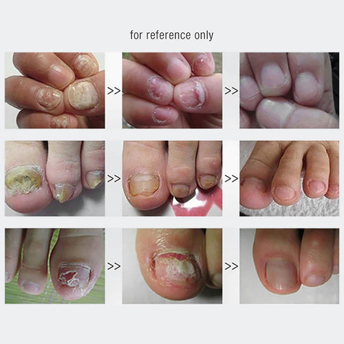Esmalte Líquido Reparador De Uñas Y Líquido Para Uñas Y Uñas