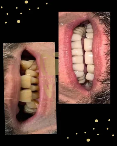 Carilla Dental En Resina (precio Por Unidad)