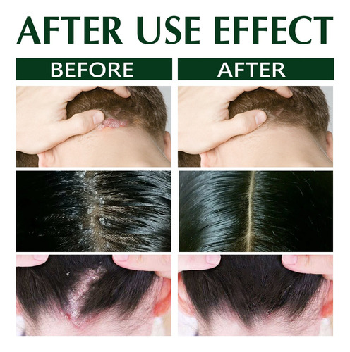 2×shampoo Seborreico Para Tratamento Dermatites E