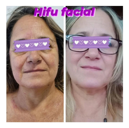 Sesion Hifu 7d Rostro + Cuello + Papada +escote