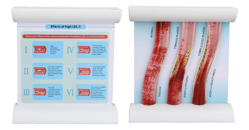 Lípido De Baja Densidad Ldl Modelo De Vaso Sanguíneo Lipopro