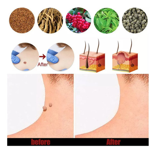 , 2*pomada Para Eliminar Verrugas Por Herpes Genital