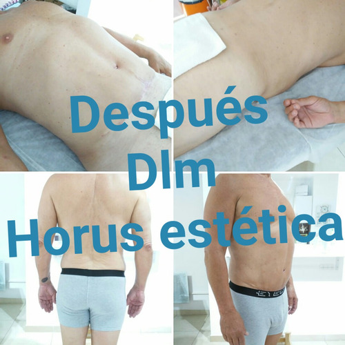 Imagen 3 de 10 de Drenaje Linfático Manual Post Quirúrgicos: Especialización