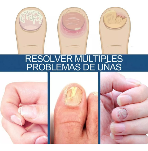 32 Parches Reparacion Uñas Nail Hongos Extracto De Hierbas