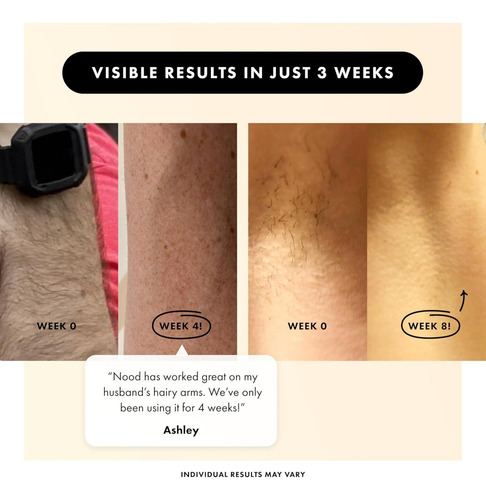 The Flasher 2.0 Nood Depiladora Laser Permanente Ipl Device