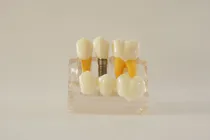Comprar Macromodelo Odontologico Puente Con Implante