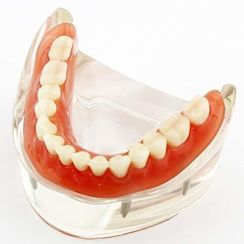 Modelo De Enseñanza Dental Sobredentadura Inferior Con 4