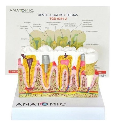 Patologia Dentária E Placa Explicativa Em 2 Partes, Anatomia
