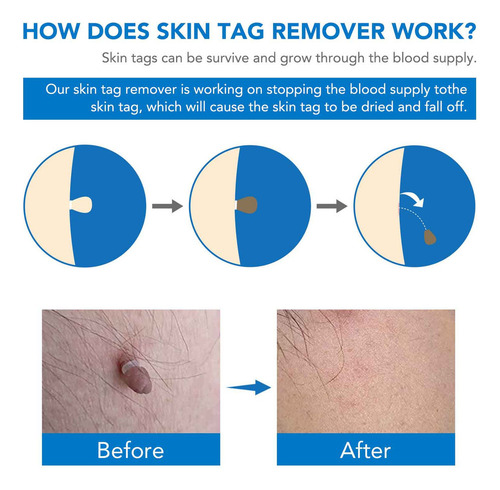 Micro Skin Tag Remover Kit De Eliminación De Etiquetas