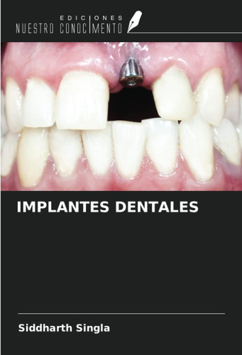 Libro: Implantes Dentales (spanish Edition)