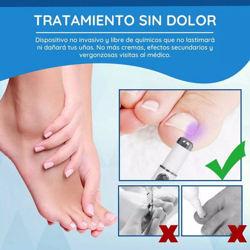 3 Pluma Luz Azul Elimina Hongo Cuidado Uñas Reparación Láser