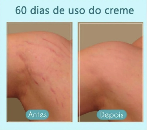 Imagem 6 de 10 de Kit Creme Cicatribem 150g + Esfoliante 120g Tira Estrias