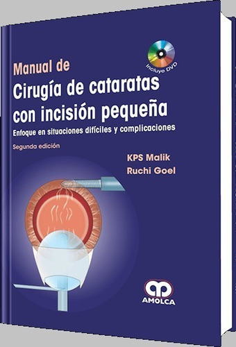Manual De Cirugía De Cataratas Con Incisión Pequeña
