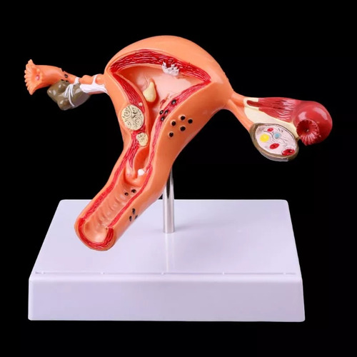 Maqueta De Utero Con Patologia 