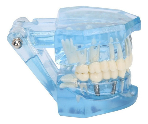 Youpin Dientes Dentales Modelo Acrílico Azul Transparente