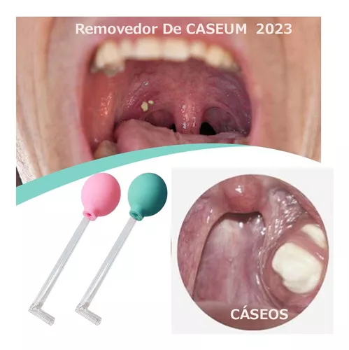 Como retirar BOLINHAS FEDORENTAS  CÁSEOS da garganta em 1 MINUTO ! 