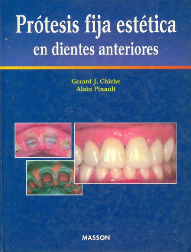 Libro Protesis Fija Estetica En Dientes Anteriores De Gerard