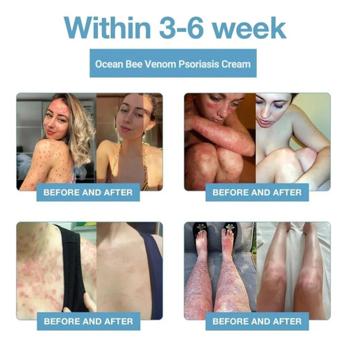 1pc Crema Curativa Para Psoriasis Piguay Bee & Ocean